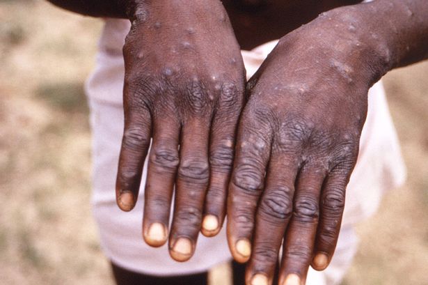 Mpox Cases Rise To 19