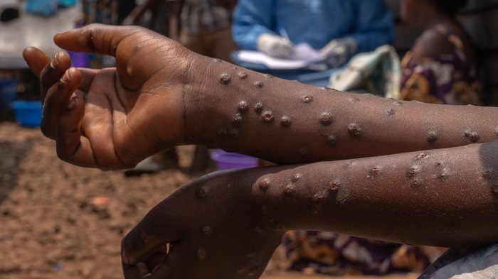 Mpox Cases Surge To 467 